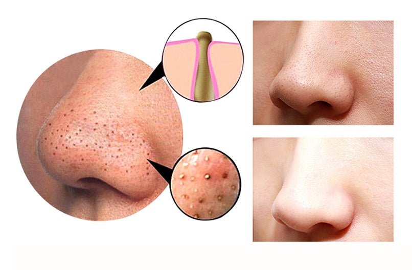 4 in 1 Body Guasha Cupping Blackhead Remover - AmiraMart