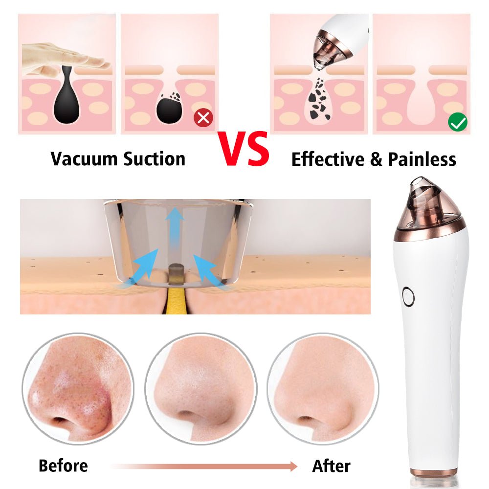 4 in 1 Body Guasha Cupping Blackhead Remover - AmiraMart