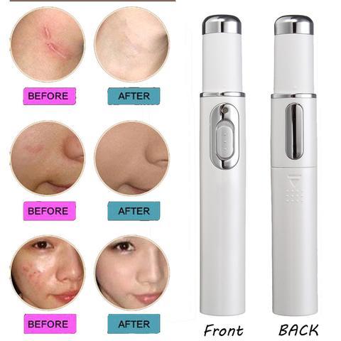 Blue Light Therapy Acne Laser Pen - AmiraMart