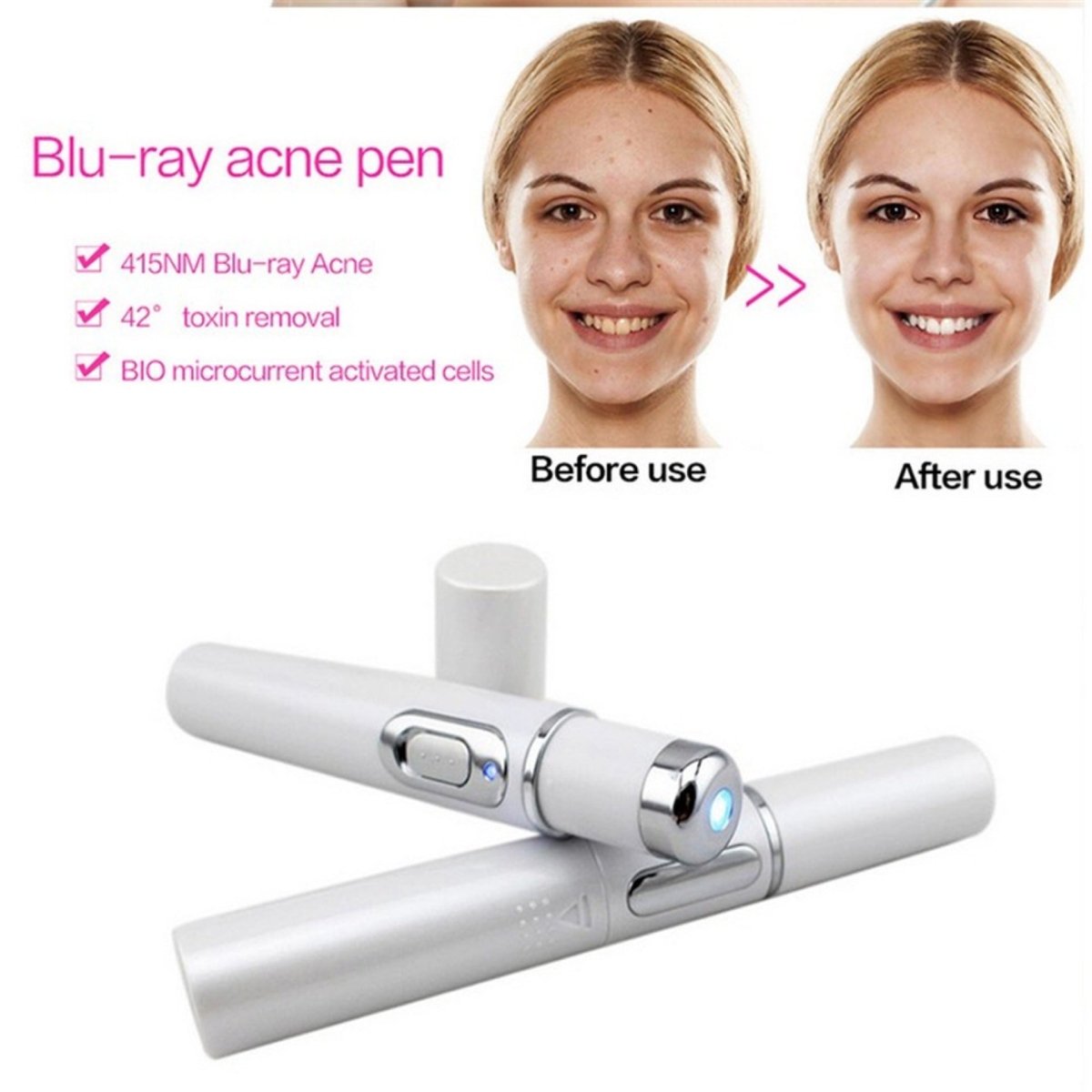 Blue Light Therapy Acne Laser Pen - AmiraMart