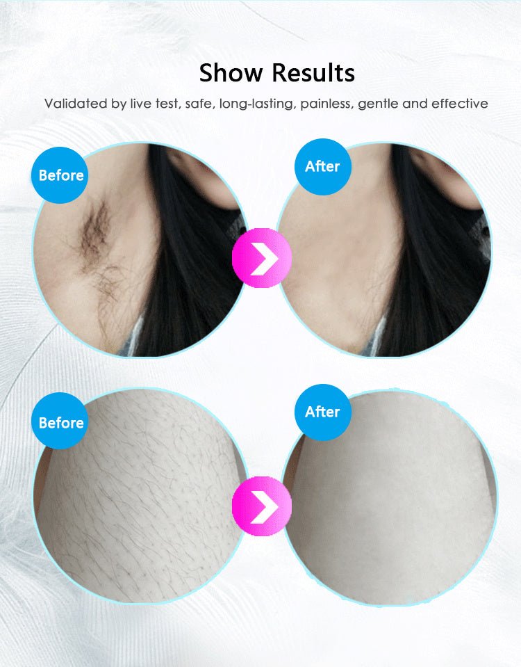 Laser Hair Removal Equipment - AmiraMart